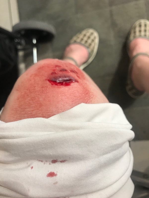 Le genou explosé d'une blogueuse en série